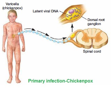 Primary infection-Chickenpox