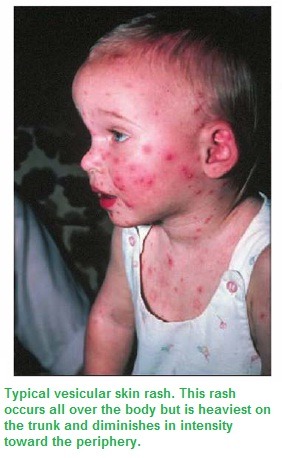 Chickenpox disease