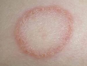 Fungal Disease - Microbiology Notes
