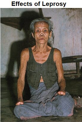 Effects of Leprosy