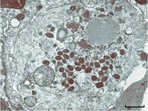 Electron microscope image of smallpox viruses