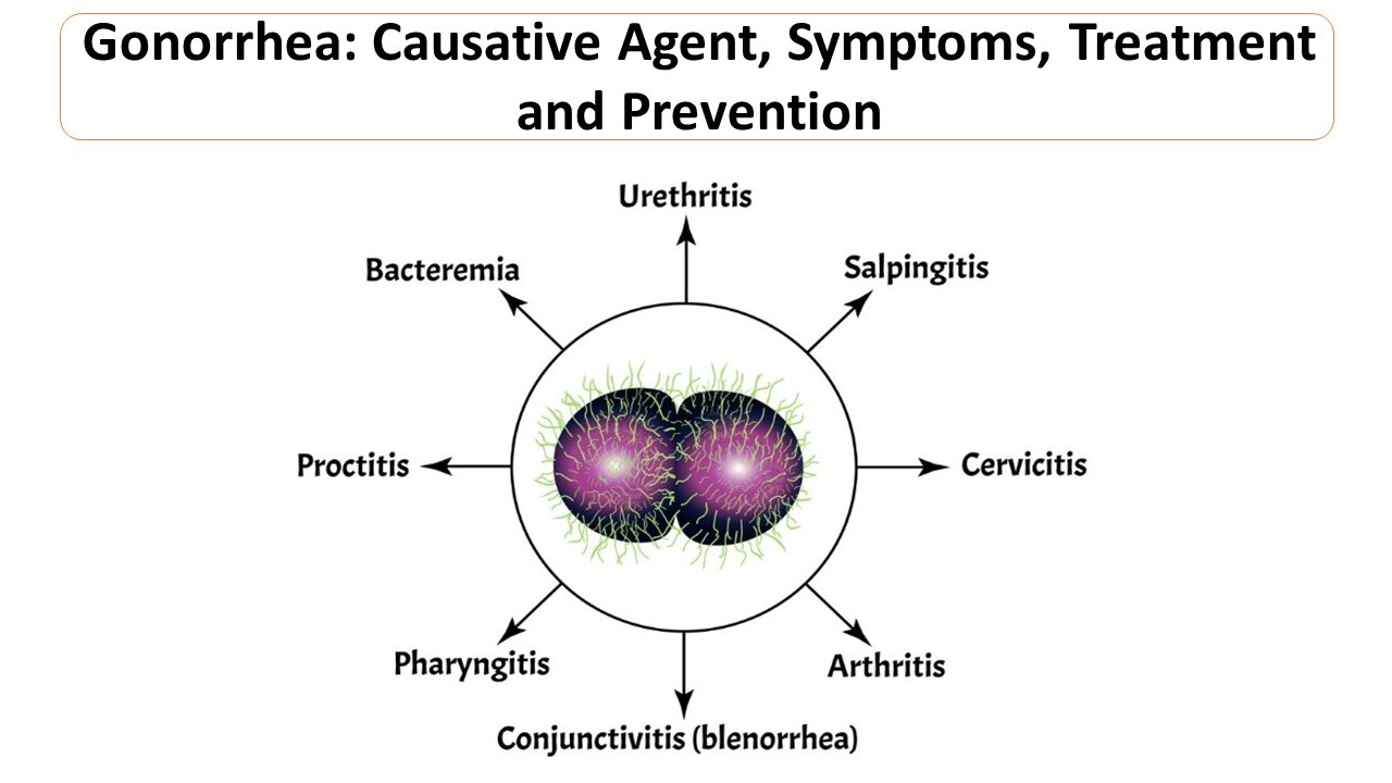 Gonorrhea Causative Agent Symptoms Treatment And Prevention 