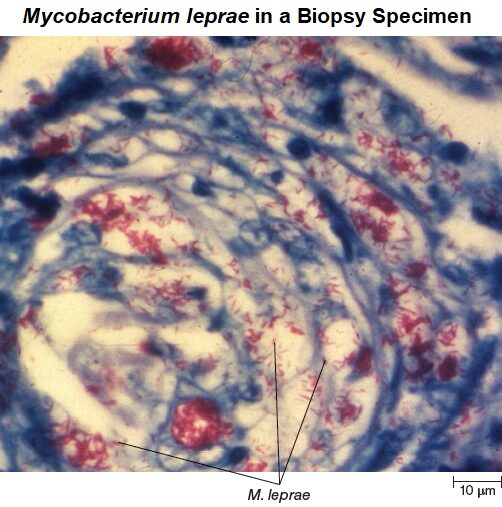 Mycobacterium leprae in a Biopsy Specimen