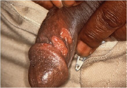 Primary syphilis occurs on the penis
