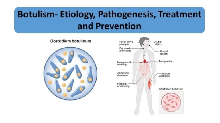 Botulism- Etiology, Pathogenesis, Treatment and Prevention