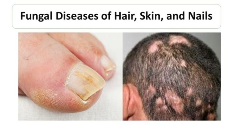 Fungal Diseases of Hair, Skin, and Nails