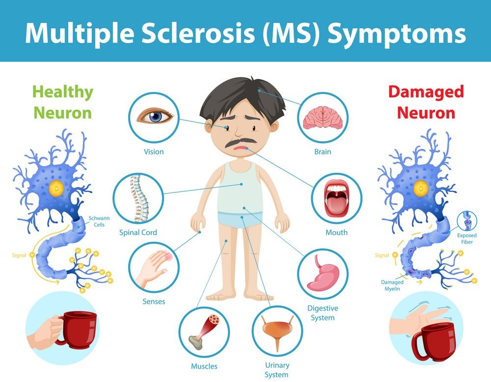 Multiple Sclerosis: Introduction, Symptoms, Causes and Diagnosis