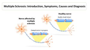 Multiple Sclerosis Diagnosis - Microbiology Notes