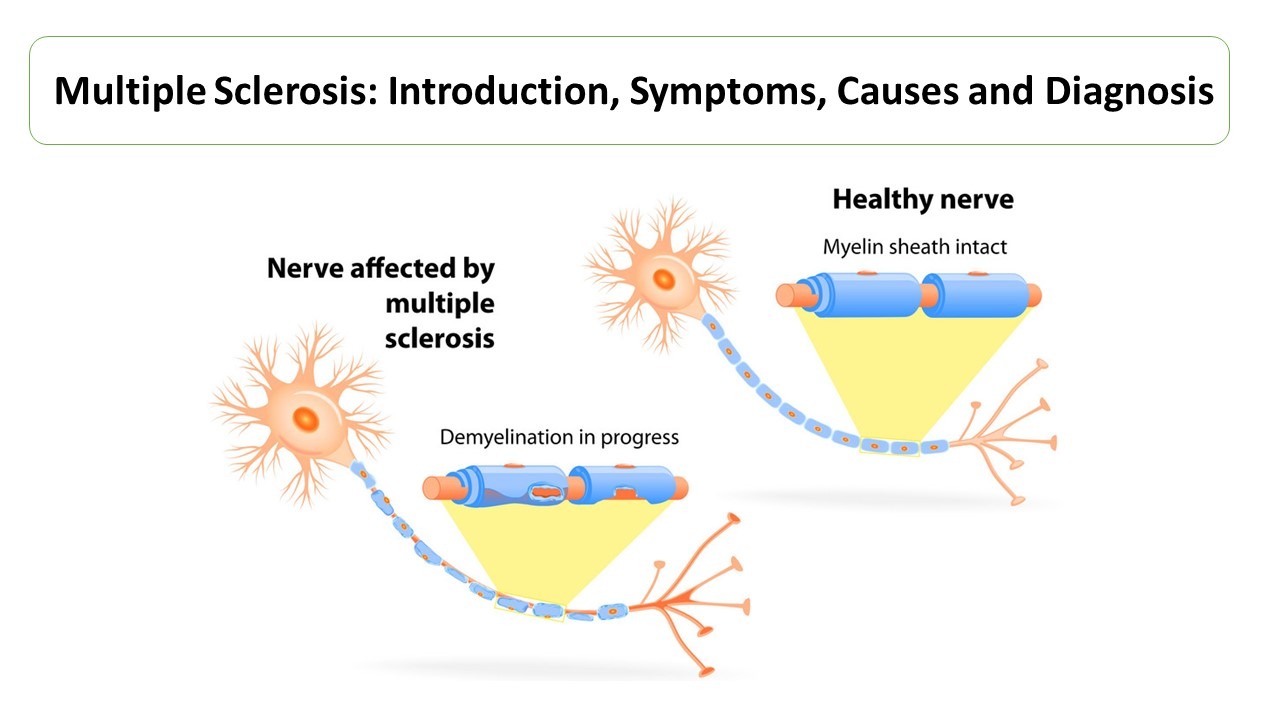 Multiple Sclerosis Introduction Symptoms Causes And Diagnosis