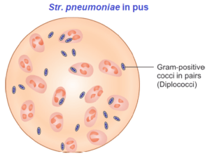 Structure of pneumoniae in pus